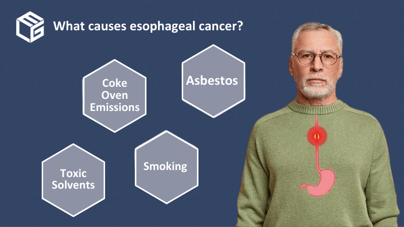Esophageal cancer claims video